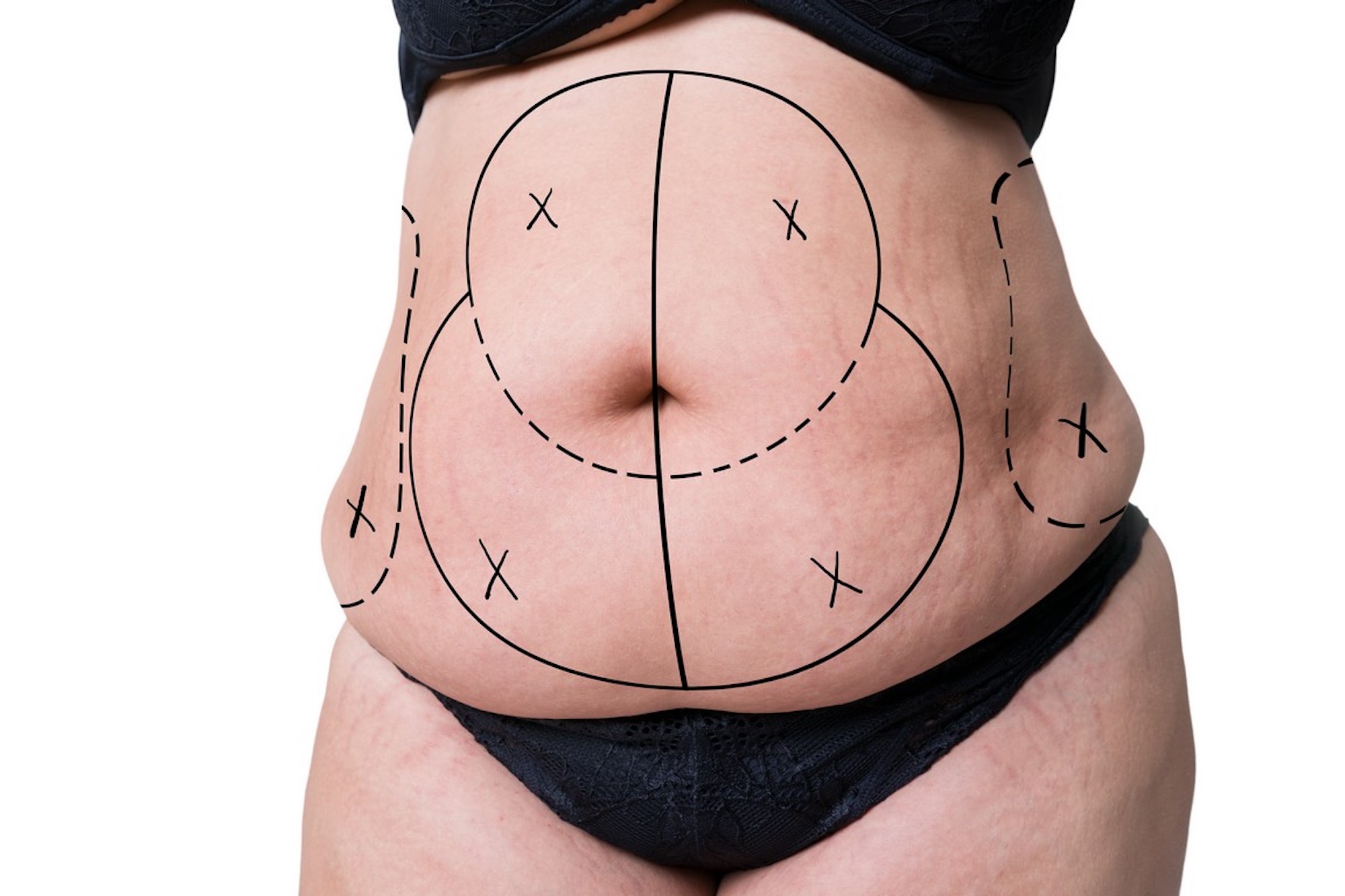 Preguntas frecuentes sobre la abdominoplastia o cirugia estetica